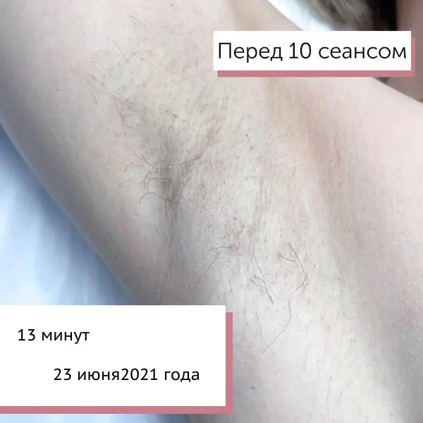 Подмышки после 10 процедур электроэпиляции