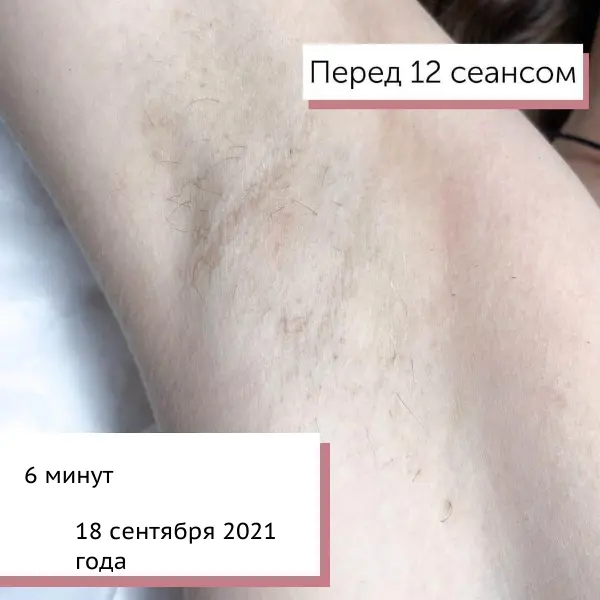 Подмышки после 12 процедур электроэпиляции — финальный результат