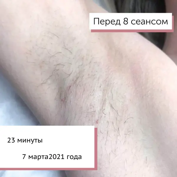 Подмышки после 8 процедур электроэпиляции