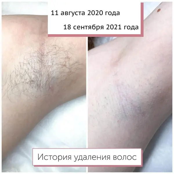Электроэпиляция подмышек: результат до и после курса